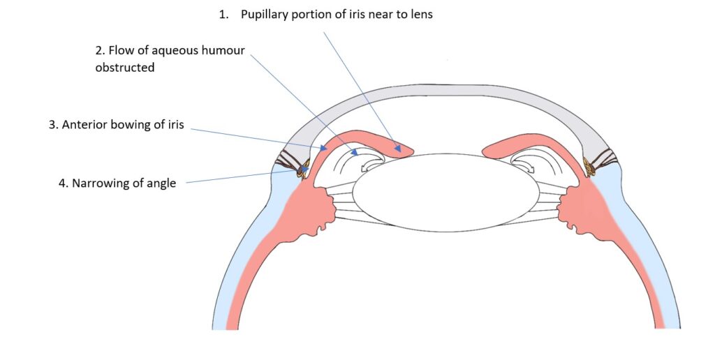 Primary Angle Closure Pathologia